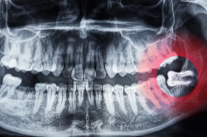 Extracción de tercer molar