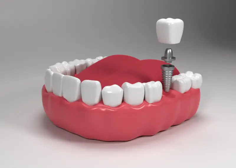 Implante dental